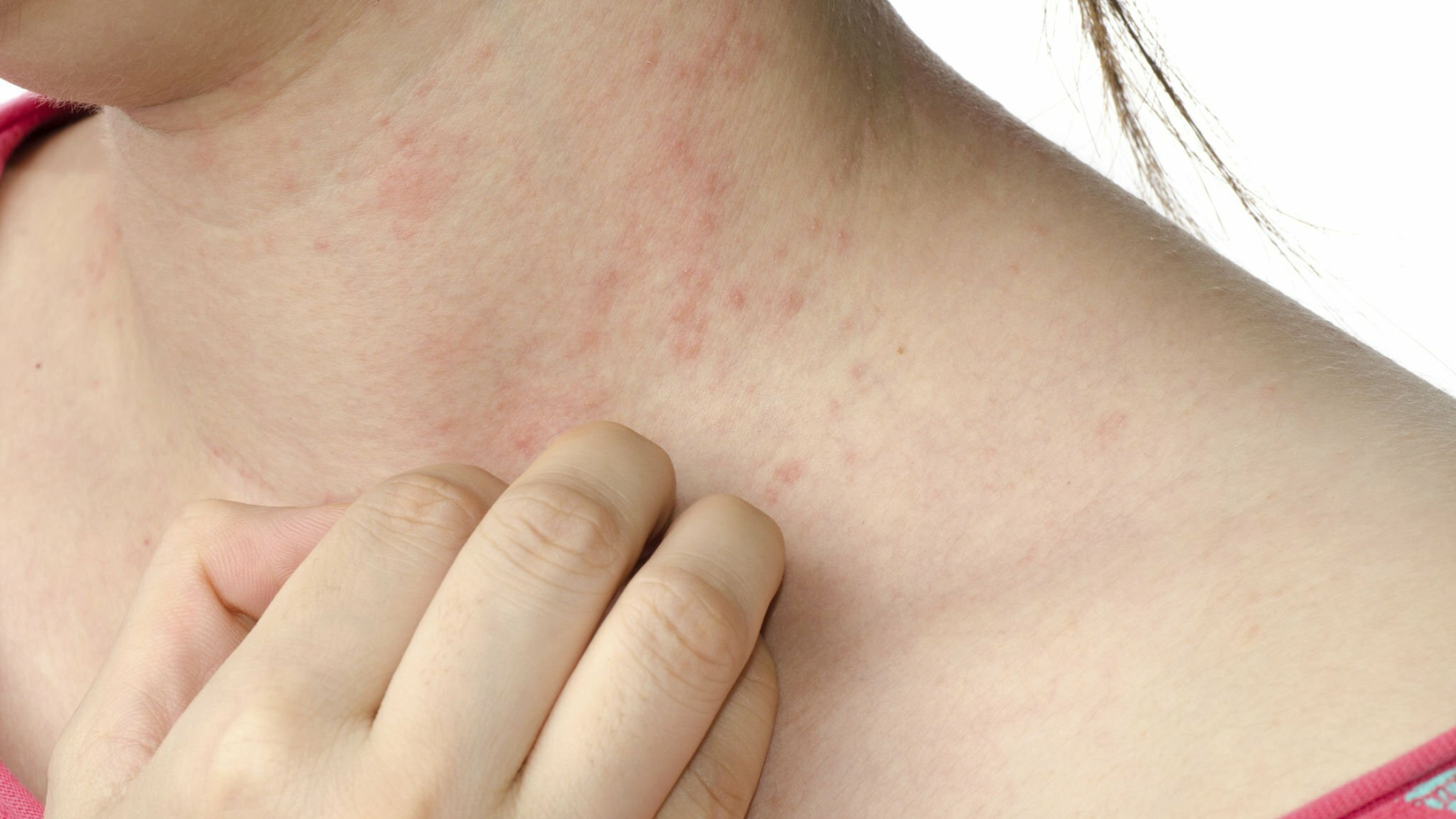 The Most Common Type of Eczema: Atopic dermatitis