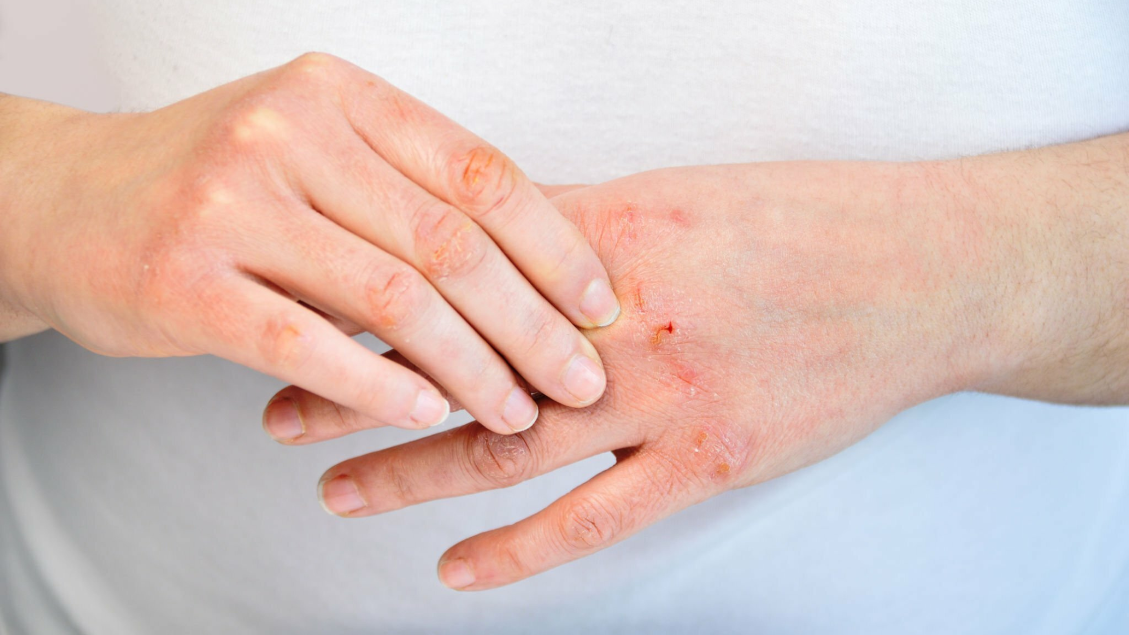 What is Dermatitis?