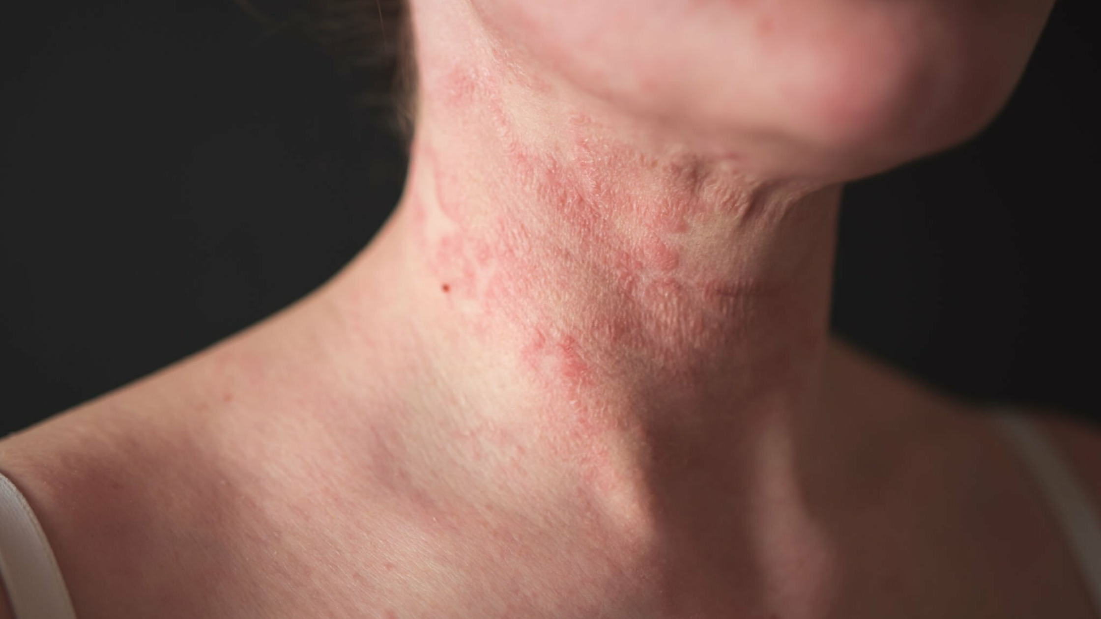 What Does Eczema Look Like?