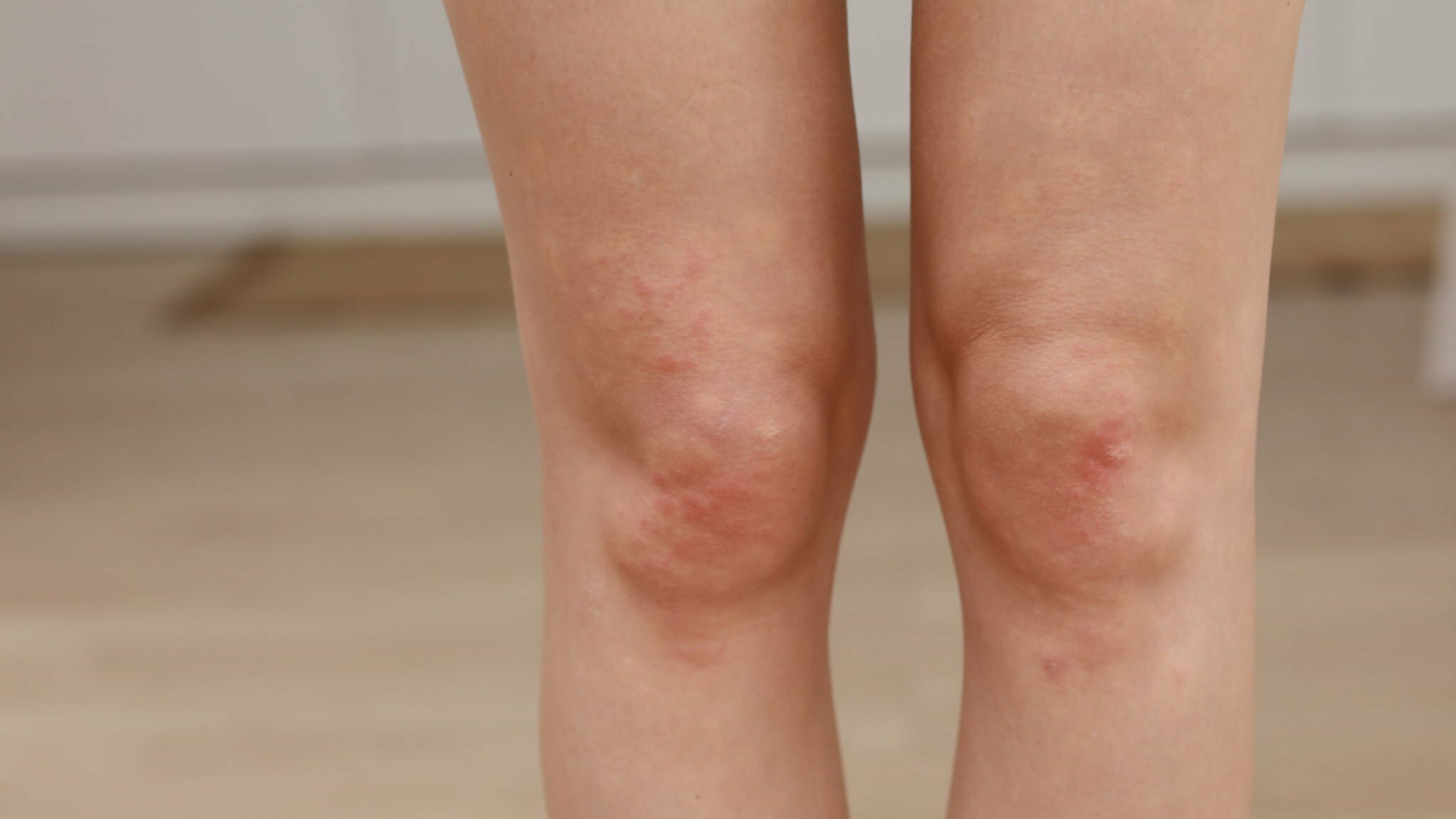 How to Prevent Staph Infections When You Have Eczema