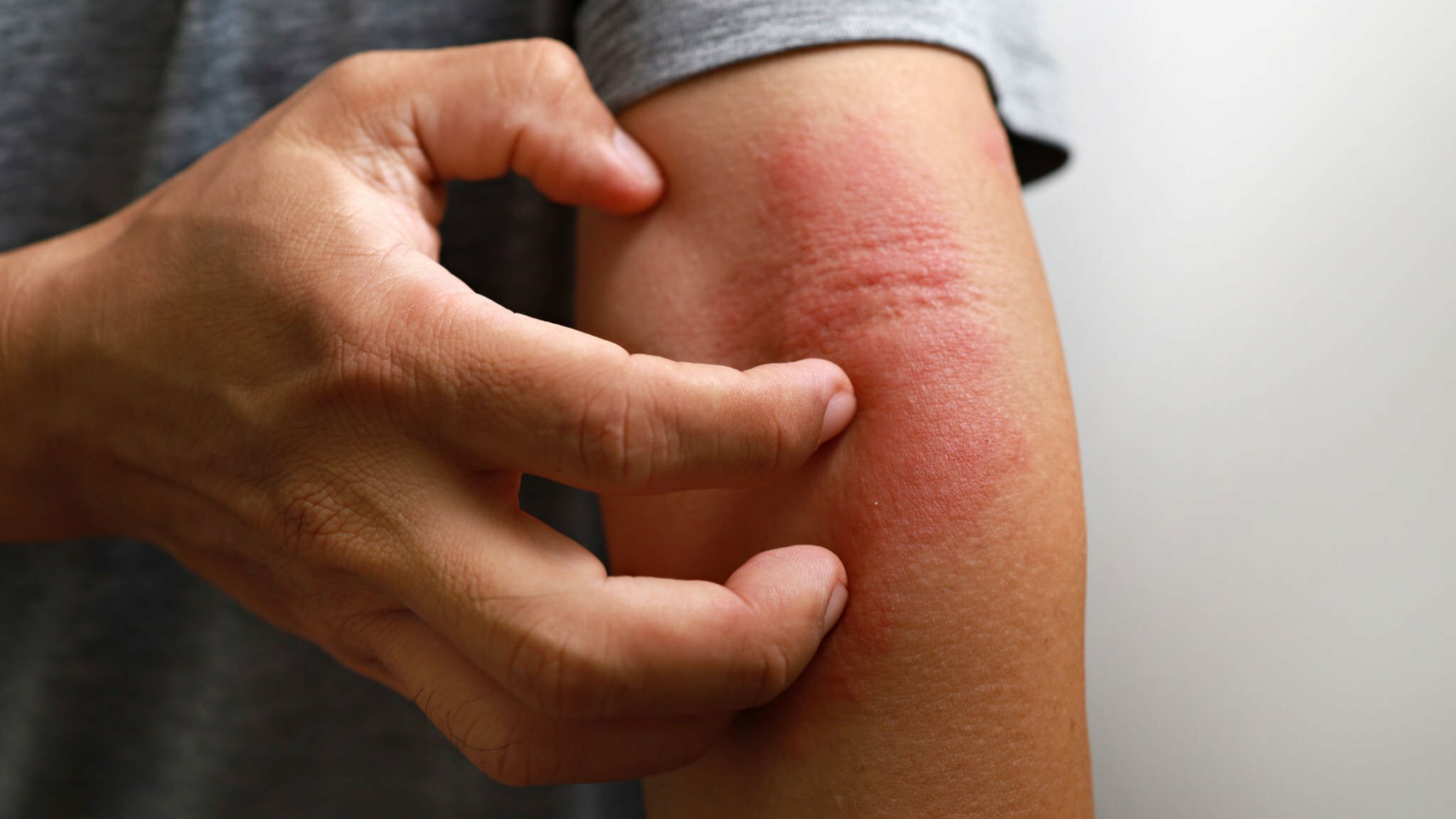 The 7 Types of Eczema
